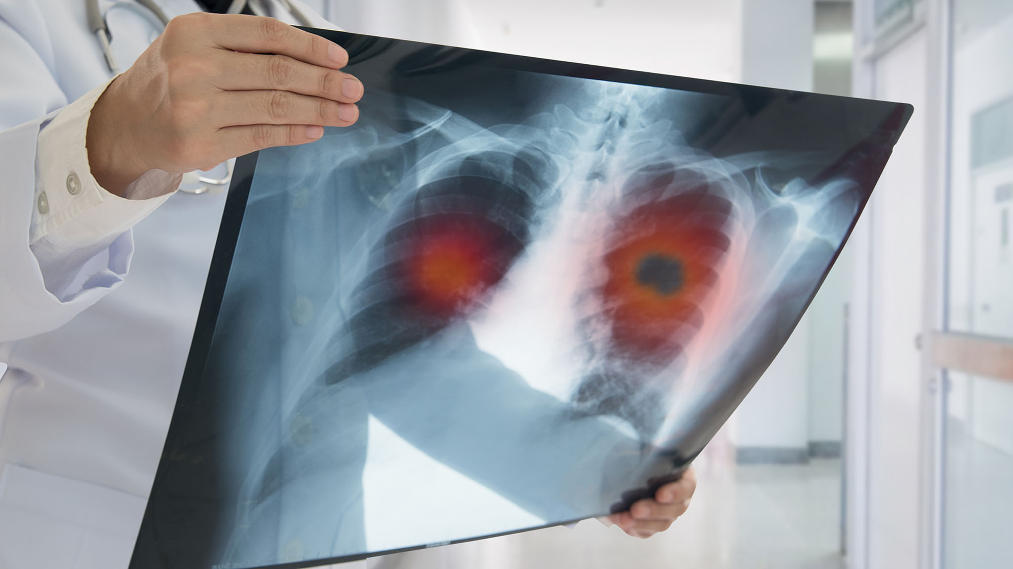 10 Myths About Lung Cancer Debunked by a Thoracic Surgeon